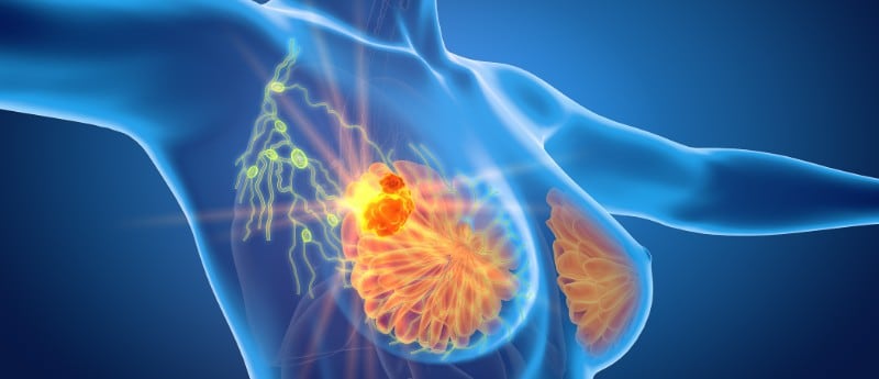 Cáncer de mama: cuándo hay que hacerse la mamografía, si tenés antecedentes familiares